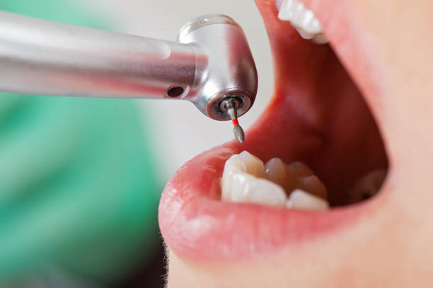 Best Emergency Dental Care for Broken or Chipped Teeth in Clisle, AR
